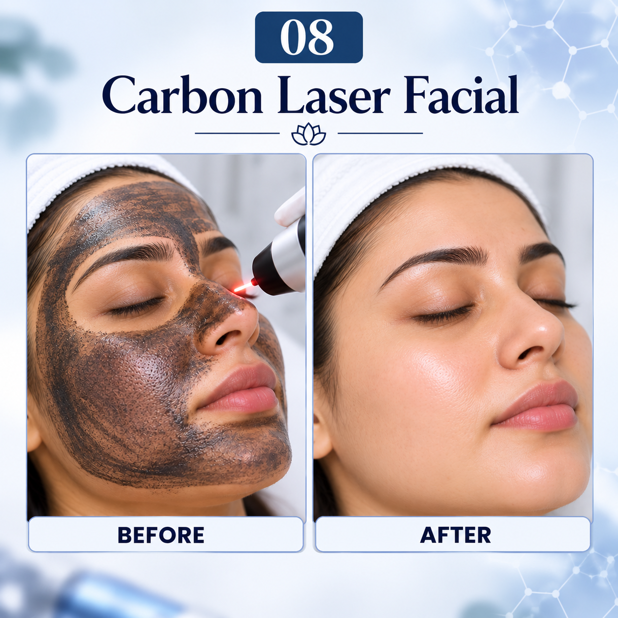 Carbon laser facial treatment result