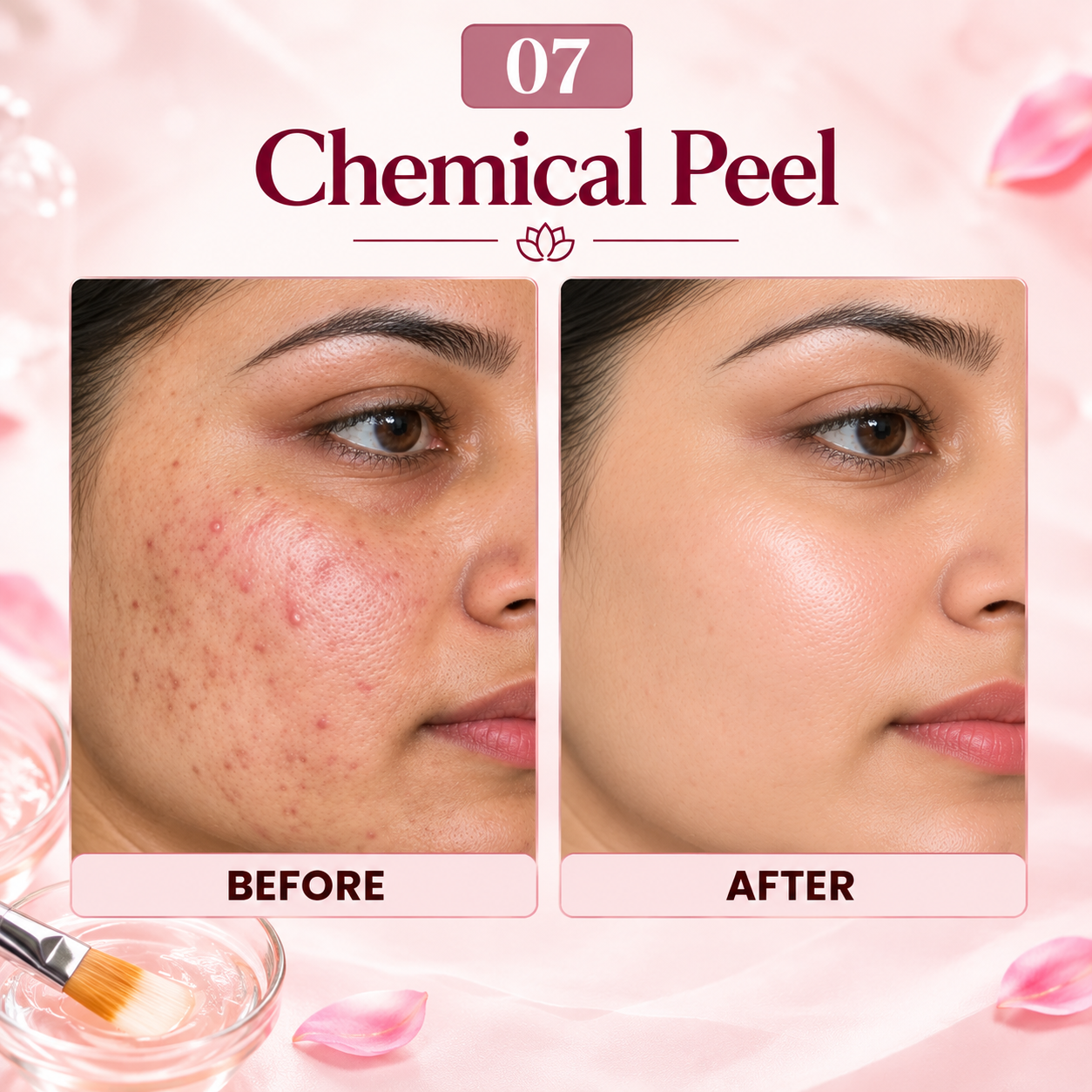 Chemical peel treatment result