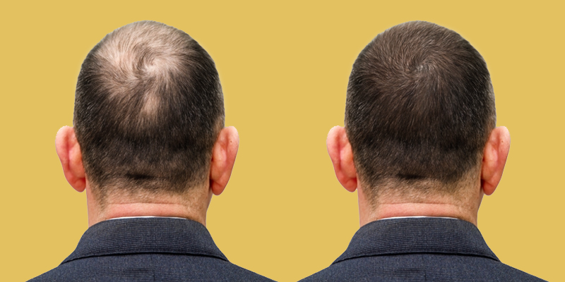 Best Hair Transplant In Noida