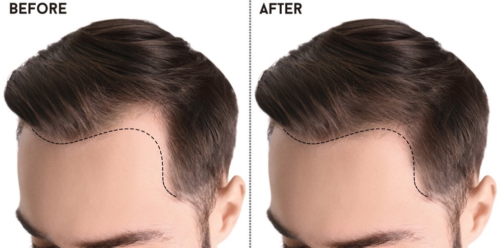 Best Hair Transplant Doctor Near Me In Noida