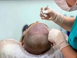 Best Hair Transplant Clinic Near Me In Noida