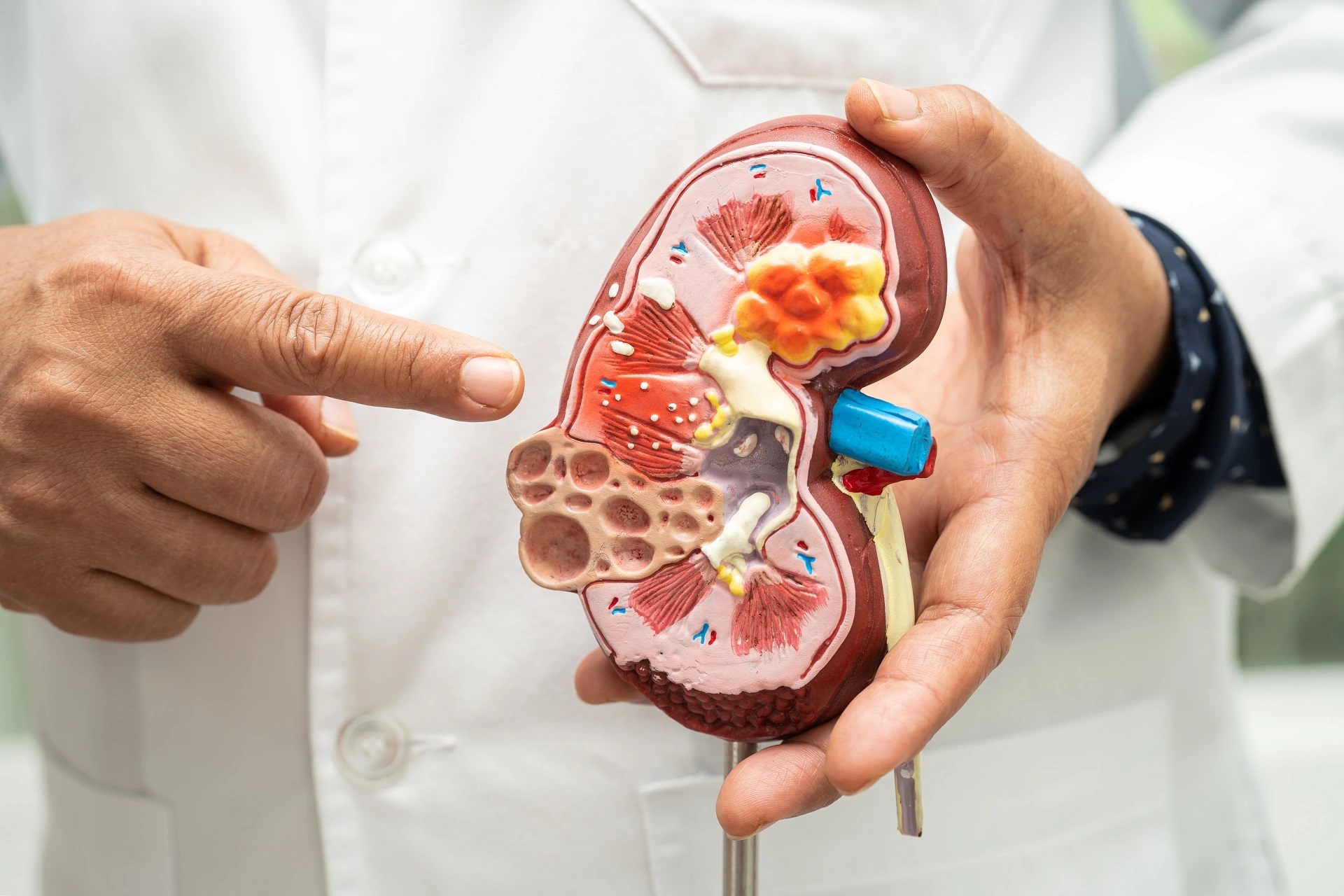 Dialysis & Kidney Treatment: Advice from Expert Nephrologists