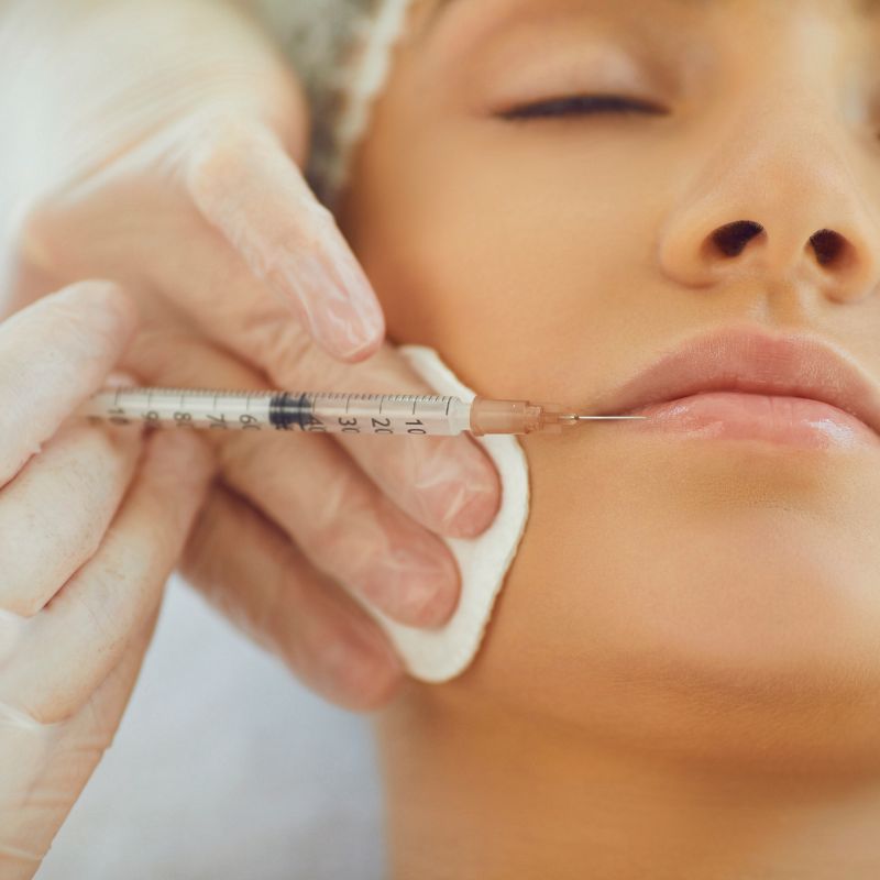 Lip Augmentation